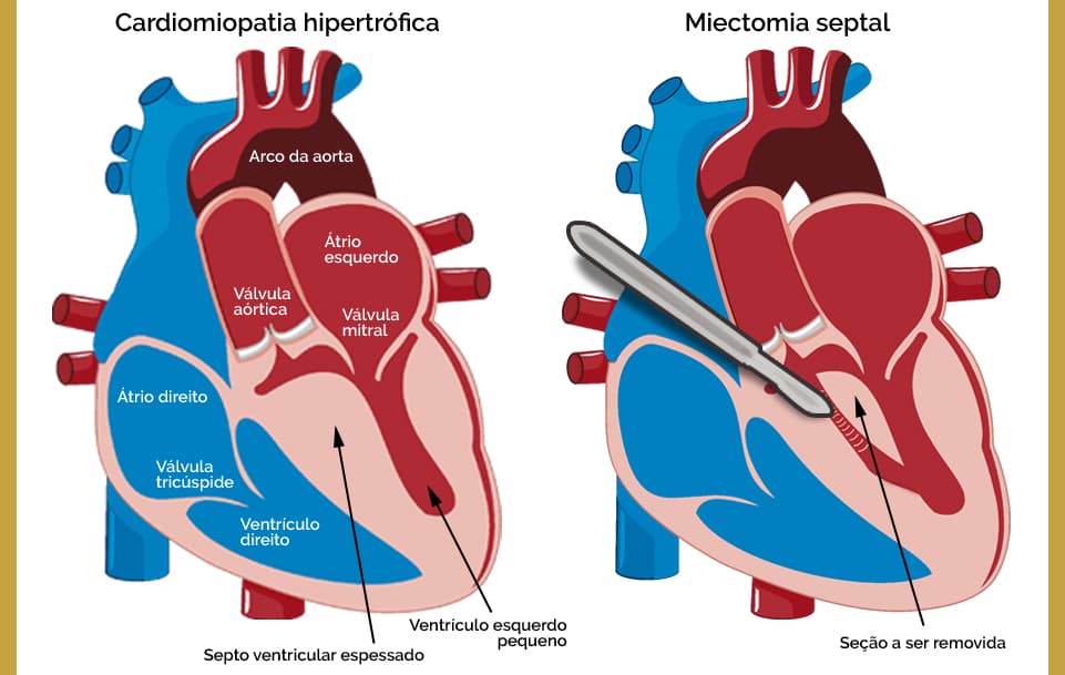 Cardiomiopatia Hipertrófica com septo ventricular espessado.