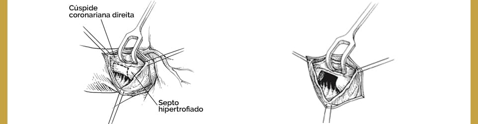 Cúspide coronariana direita com septo hipertrofiado.