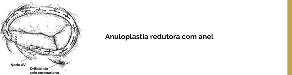 Anuloplastia redutora com anel.