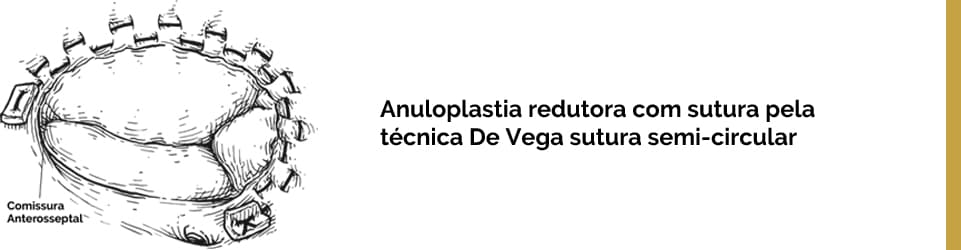 Anuloplastia redutora com sutura pela técnica De Vega - sutura semi-circular.