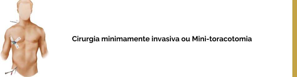 Cirurgia minimamente invasiva ou Mini-toracotomia.