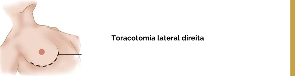 Toracotomia lateral direita é um acesso muito seguro.