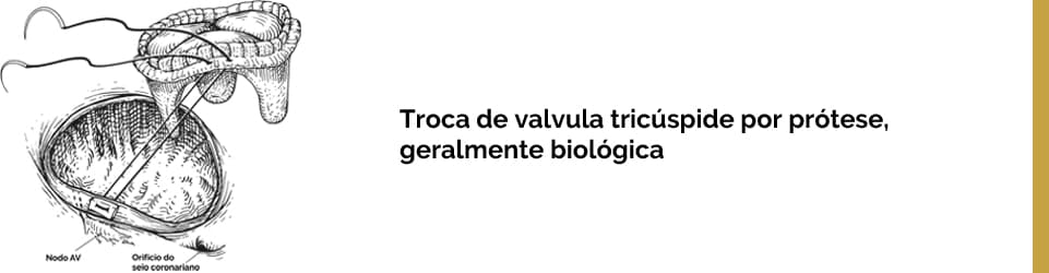 Troca de valvula tricúspide por prótese, geralmente biológica.