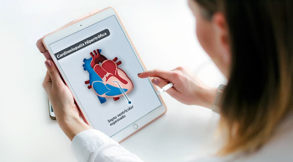 Procedimento: Cardiomiopatia Obstrutiva Hipertrófica (Hipertrofia Septal Assimétrica)