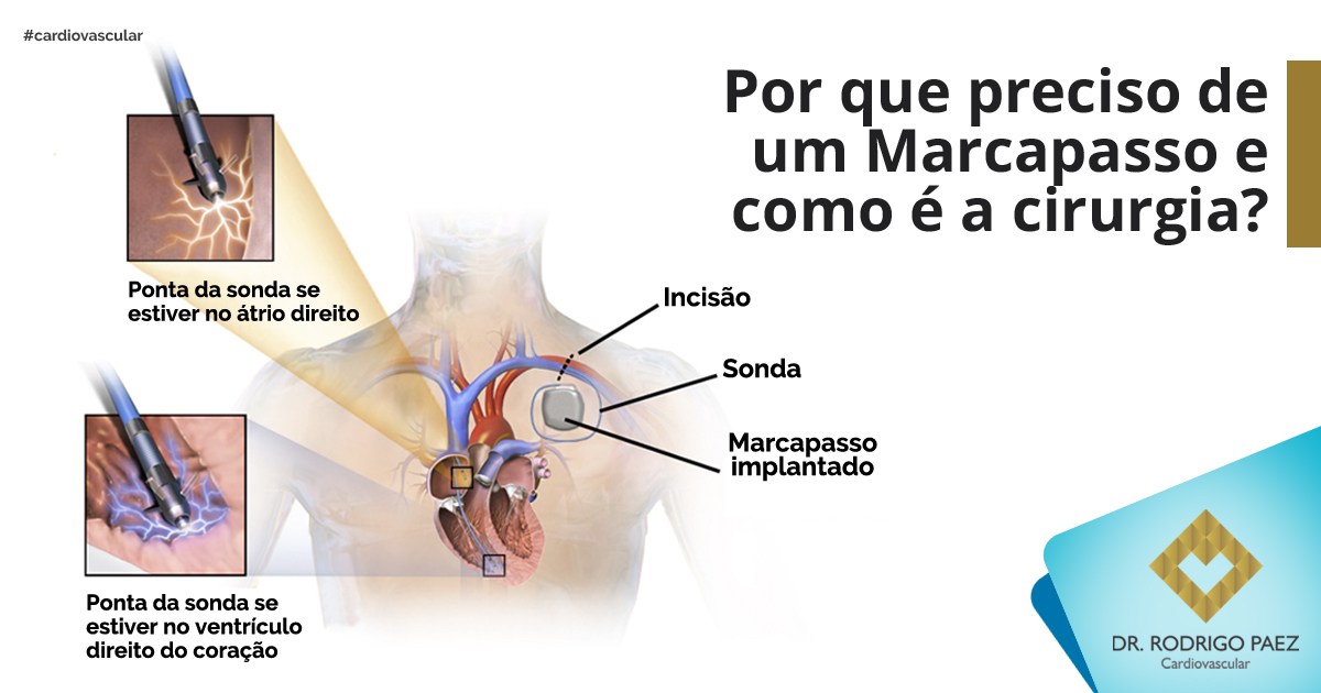 Confira o que muda na vida de quem tem marcapasso - Saúde