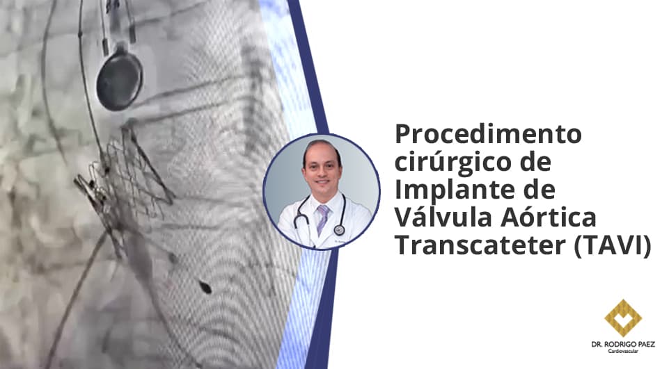 Procedimento cirúrgico de Implante de Válvula Aórtica Transcateter (TAVI).